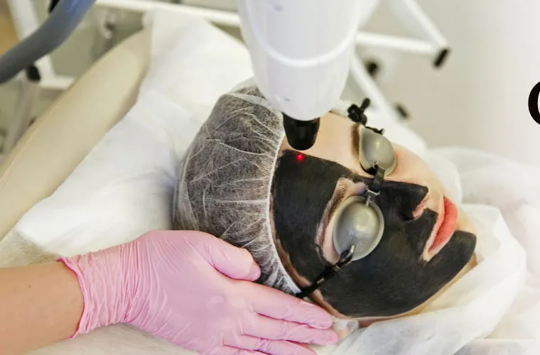 Laser carbon facial being performed with a carbon mask