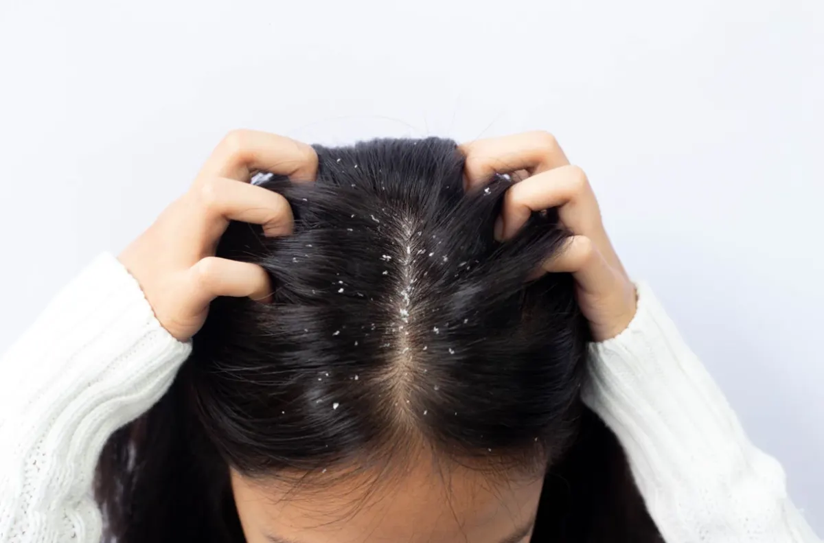Woman with dandruff flakes on her scalp